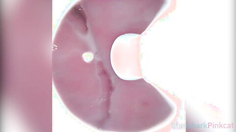 Camera Inside Vagina After Internal Creampie ส่องกล้องดูอสุจิในช่องคลอ